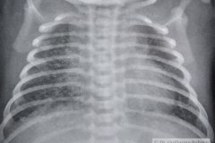 enfermedad-membrana-hialina-emh-ii-2005-001