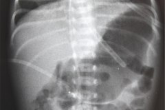 enfermedad-membrana-hialina-emh-ii-gastroparesia-1999-000