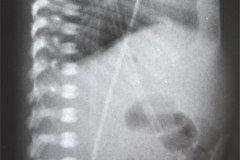 enfermedad-membrana-hialina-emh-ii-gastroparesia-1999-001