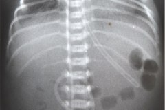 enfermedad-membrana-hialina-emh-ii-gastroparesia-1999-002