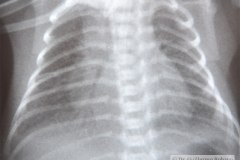 enfermedad-membrana-hialina-emh-ii-gastroparesia-1999-004