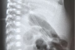 enfermedad-membrana-hialina-emh-ii-gastroparesia-1999-005