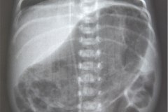 enfermedad-membrana-hialina-emh-ii-gastroparesia-1999-007