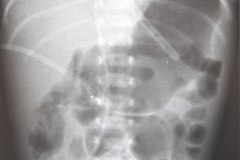 enfermedad-membrana-hialina-emh-ii-gastroparesia-1999-009