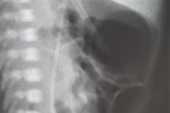 enfermedad-membrana-hialina-emh-ii-gastroparesia-1999-010