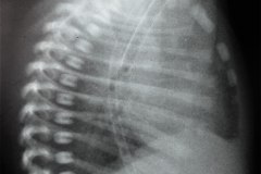 enfermedad-membrana-hialina-emh-ii-iii-2002-000