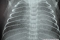 enfermedad-membrana-hialina-emh-ii-iii-2002-001