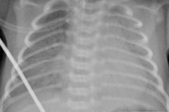 enfermedad-membrana-hialina-emh-iii-iv-2009-000