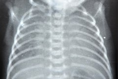 enfermedad-membrana-hialina-emh-iv-1.a-y-2.a-dosis-surfactante-rn5d-1997-001
