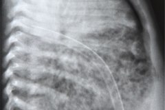 enfermedad-membrana-hialina-emh-iv-atelectasica-lobulo-medio-lobulo-inferior-der-completa-izquierda-neumotorax-enfisema-intersticial-2013-000