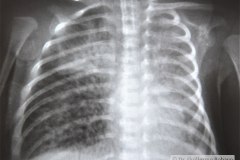 enfermedad-membrana-hialina-emh-iv-atelectasica-lobulo-medio-lobulo-inferior-der-completa-izquierda-neumotorax-enfisema-intersticial-2013-001