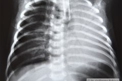 enfermedad-membrana-hialina-emh-iv-atelectasica-lobulo-medio-lobulo-inferior-der-completa-izquierda-neumotorax-enfisema-intersticial-2013-005