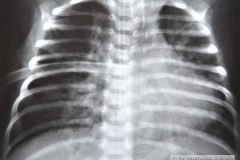 enfermedad-membrana-hialina-emh-iv-atelectasica-lobulo-medio-lobulo-inferior-der-completa-izquierda-neumotorax-enfisema-intersticial-2013-006