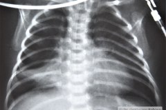 enfermedad-membrana-hialina-emh-iv-atelectasica-lobulo-medio-lobulo-inferior-der-completa-izquierda-neumotorax-enfisema-intersticial-2013-013