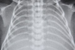 enfermedad-membrana-hialina-emh-iv-atelectasica-lobulo-medio-lobulo-inferior-der-completa-izquierda-neumotorax-enfisema-intersticial-2013-014