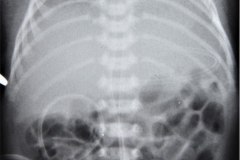 enfermedad-membrana-hialina-emh-iv-atelectasica-lobulo-medio-lobulo-inferior-der-completa-izquierda-neumotorax-enfisema-intersticial-2013-016