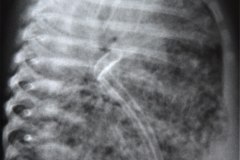 enfermedad-membrana-hialina-emh-iv-atelectasica-lobulo-medio-lobulo-inferior-der-completa-izquierda-neumotorax-enfisema-intersticial-2013-019