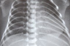 enfermedad-membrana-hialina-emh-iv-atelectasica-lobulo-medio-lobulo-inferior-der-completa-izquierda-neumotorax-enfisema-intersticial-2013-021