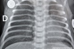 enfermedad-membrana-hialina-emh-iv-nemotorax-post-surfactantre-tubo-torax-2003-001
