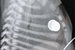 enfermedad-membrana-hialina-emh-iv-nemotorax-post-surfactantre-tubo-torax-2003-002