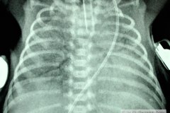 enfermedad-membrana-hialina-emh-iv-neumotorax-apical-der-broncograma-aereo-2005-000