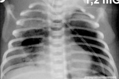 enfermedad-membrana-hialina-emh-iv-pre-y-post-1-2-dosis-surfactante-neumotorax-neumopericardio-rn3d6d-2011-002