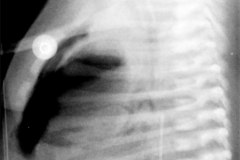 enfermedad-membrana-hialina-emh-iv-pre-y-post-1-2-dosis-surfactante-neumotorax-neumopericardio-rn3d6d-2011-006
