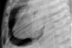 enfermedad-membrana-hialina-emh-iv-pre-y-post-1-2-dosis-surfactante-neumotorax-neumopericardio-rn3d6d-2011-008
