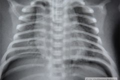 enfermedad-membrana-hialina-emh-iv-pre-y-post-1-y-2-dosis-surfactante-neumomediastino-neumoperitoneo-yelco-drenaje-rn3d5d9d15d-1992-000