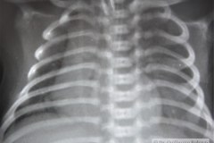 enfermedad-membrana-hialina-emh-iv-pre-y-post-1-y-2-dosis-surfactante-neumomediastino-neumoperitoneo-yelco-drenaje-rn3d5d9d15d-1992-005