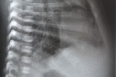 enfermedad-membrana-hialina-emh-iv-pre-y-post-1-y-2-dosis-surfactante-neumomediastino-neumoperitoneo-yelco-drenaje-rn3d5d9d15d-1992-009