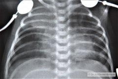 enfisema-compensatorio-o-vicariante-atelectasia-lobulo-sup-der-000