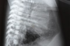 enfisema-hiperinsuflacion-pulmonar-raquisquisis-t10-1992-000