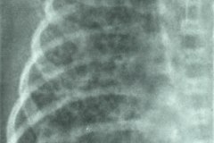 enfisema-intersticial-bil-post-emh-2004-000