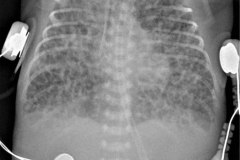 enfisema-intersticial-bil-severo-cateter-arterial-femoral-izq-y-venoso-yugular-der-2007-001
