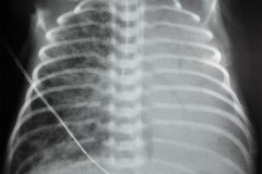 enfisema-intersticial-der-atelectasia-total-izq-tubo-sobreinsertado-000