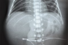 enfisema-intersticial-izq-2003-001
