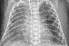 enfisema-intersticial-izq-2003-002