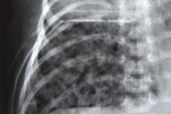 enfisema-intersticial-004