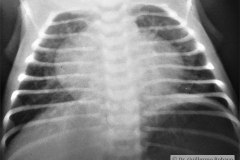 enfisema-lobar-congenito-1987-000