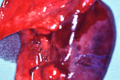 enfisema-lobar-congenito-quiste-pulmonar-1996-000