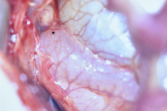 enfisema-lobar-congenito-quiste-pulmonar-1996-001