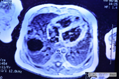enfisema-lobar-congenito-quiste-pulmonar-1996-005