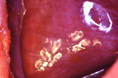 enfisema-lobar-congenito-quiste-pulmonar-1996-006