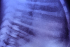 enfisema-lobar-congenito-quiste-pulmonar-1996-007