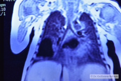 enfisema-lobar-congenito-quiste-pulmonar-1996-009