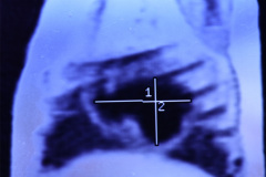 enfisema-lobar-congenito-quiste-pulmonar-1996-010