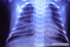 enfisema-lobar-congenito-quiste-pulmonar-1996-011