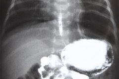 enfisema-lobar-congenito-tubo-de-torax-iatrogenico-vda-diferencia-estomago-001