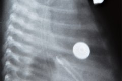 enfisema-lobar-congenito-tubo-de-torax-iatrogenico-vda-diferencia-estomago-005